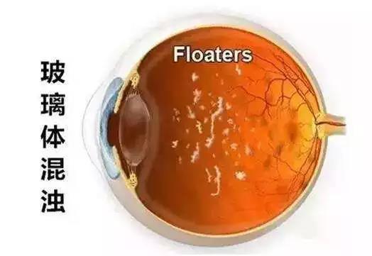 哪些人易患飞蚊症？