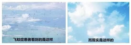 哪些人易患飞蚊症？
